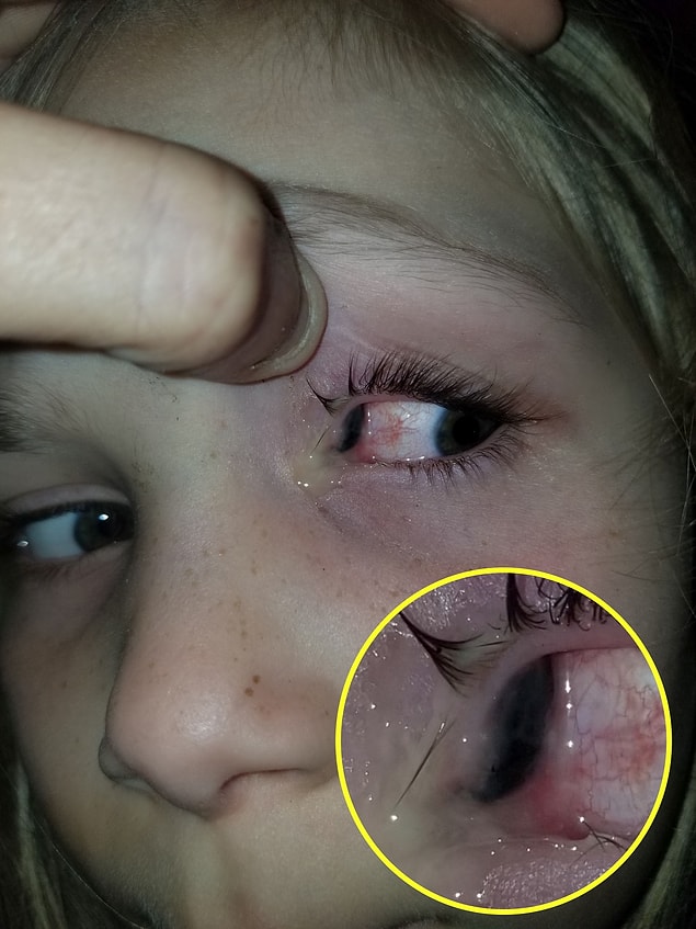 SibiKaia'nın annesi, durumu görünce kızını hemen hastaneye götürdü.