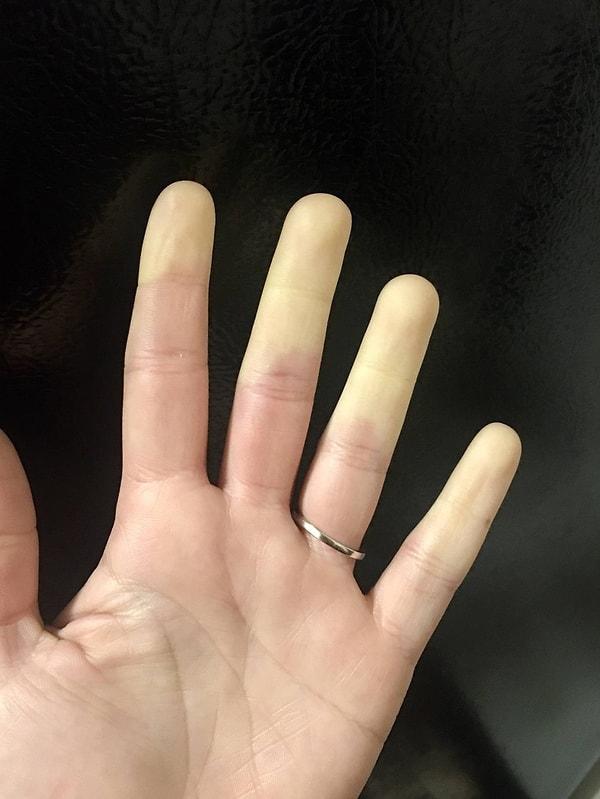 5. "Kan akışı olmadığı için parmaklarımın yarısı bu şekilde görünüyor."