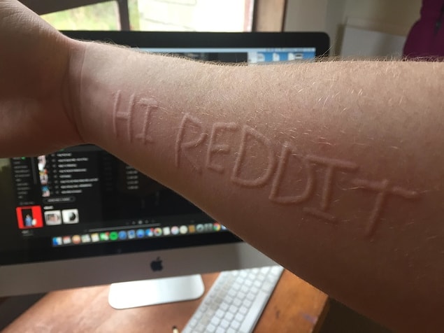6. "Dermatographia isimli bir deri hastalığım var. Bu da kolumun üzerine bir şeyler 'çizebilirim' anlamına geliyor."