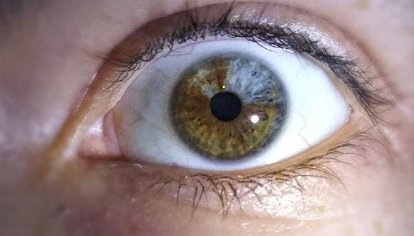 11. "Gözümün bir kısmının mavi görünmesine neden olan heterokromi isimli bir rahatsızlığım var."