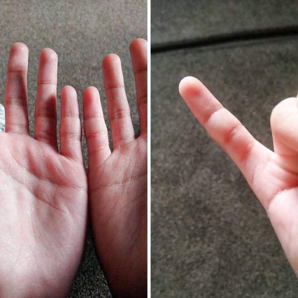 3. "У моего правого мизинца есть дополнительная фаланга"