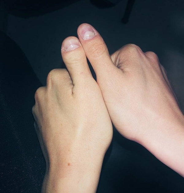 12. "У меня разные большие пальцы, по одному от каждого родителя"