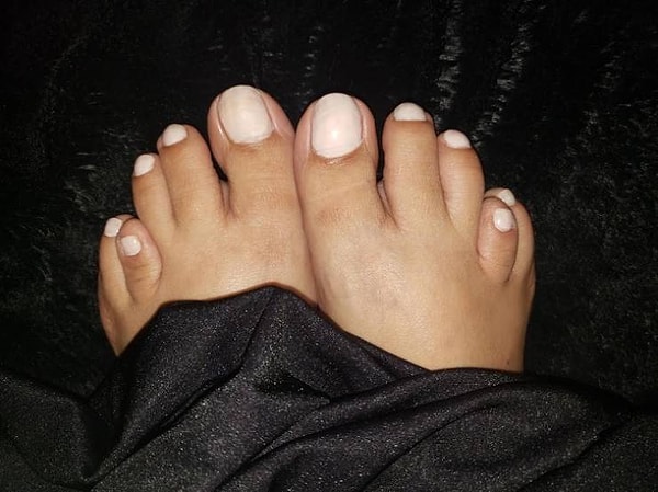 14. «У меня брахиметатарсия, и это делает мои пальцы вот такими».