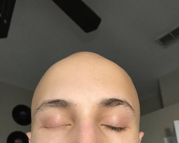 17. «У меня растут ресницы только на одном глазу».