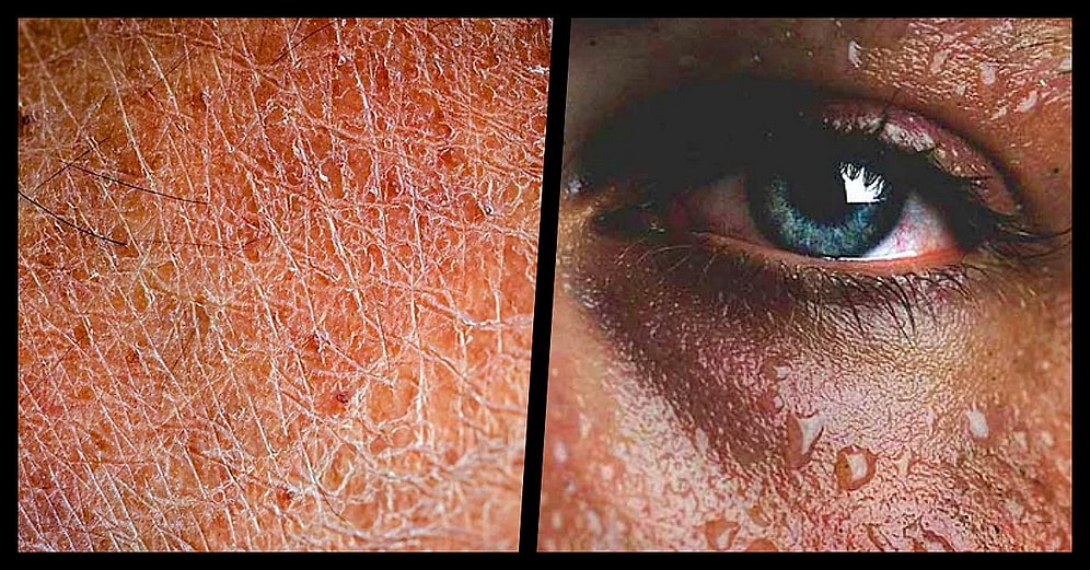 Vücudumuzda Ortaya Çıktığında Yeterli Miktarda Su Tüketmediğimizi Gösteren 15 İlginç Belirti