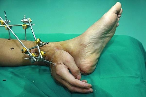 3. Bu da doktorların, hastanın ayağında aşılayarak iyileştirdikleri bir el. Bu şekilde bir ay kaldıktan sonra kola geri dikilmiş.
