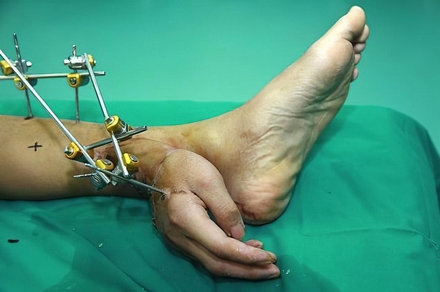 3. Bu da doktorların, hastanın ayağında aşılayarak iyileştirdikleri bir el. Bu şekilde bir ay kaldıktan sonra kola geri dikilmiş.