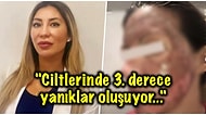 Güzelleşme Uğruna Evde Yaptıkları Kimyasal Maskelerle Ciltlerini Mahveden İnsanların Ürkütücü Hallerine Çok Şaşıracaksınız!