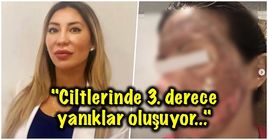 Güzelleşme Uğruna Evde Yaptıkları Kimyasal Maskelerle Ciltlerini Mahveden İnsanların Ürkütücü Hallerine Çok Şaşıracaksınız!