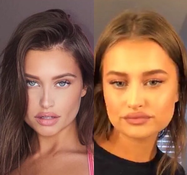 Именно по этой причине количество пластических операций и косметических процедур резко возросло за последние 5-10 лет.