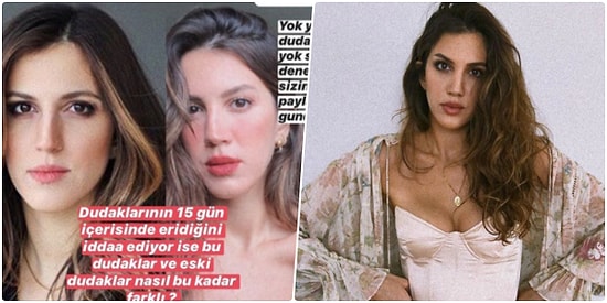 Dudağında Dolgu Olmadığını Söyleyen Arda Türkmen'in Sevgilisi Melodi Elbirliler'e Estetik Kliniğinden Yalanlama Geldi!