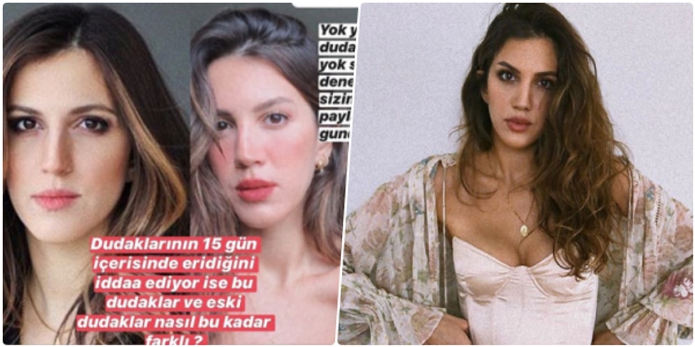 Dudağında Dolgu Olmadığını Söyleyen Arda Türkmen'in Sevgilisi Melodi Elbirliler'e Estetik Kliniğinden Yalanlama Geldi!