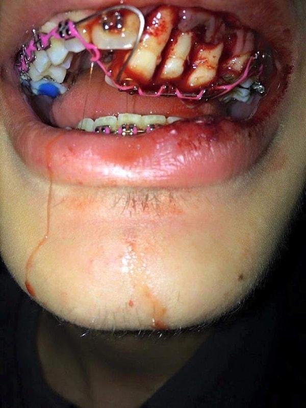 1. "Diş telleri varken ağzınıza yumruk yerseniz böyle oluyor."