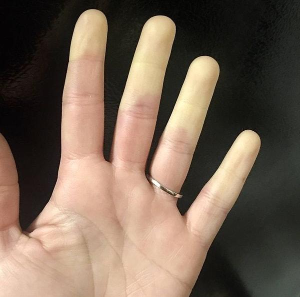 10. "Raynaud hastalığım yüzünden parmaklarımdan kan çekilmiş gibi duruyor."