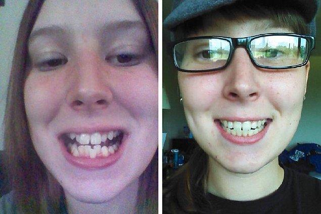 2. "Dün diş tellerimden kurtuldum. 2 buçuk sene sonra özgürce gülümseyebilmek harika bir duygu."