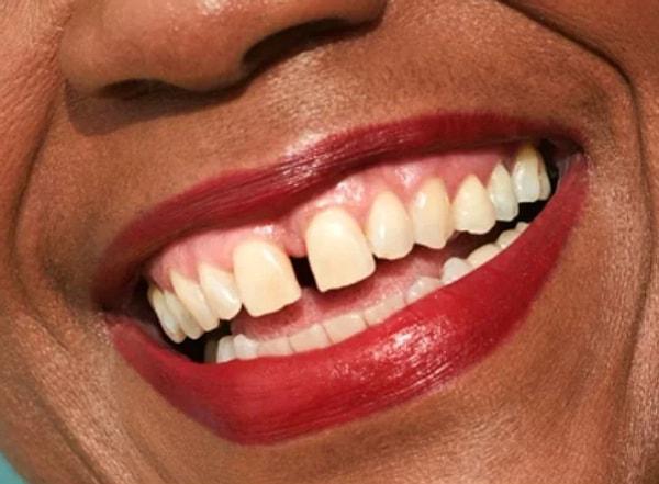 9. "Dişlerin arasındaki boşluğa diyastema denildiğini öğrendiğinizde kaç yaşındaydınız?"