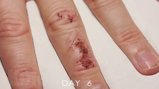 33 Günde İyileşen Yaranın Time Lapse Olarak Kaydedilen Muhteşem İyileşme Görüntüleri