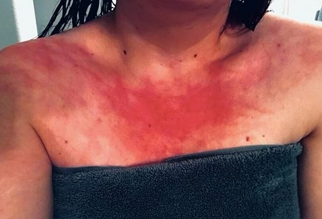 Suya alerjisi olan 23 yaşındaki Racheel Fetter, cildinin her suyla temasında ciddi bir acı çekiyor.