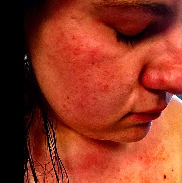 Bütün dünyada sadece 50 kişide var olan bu alerjiden ötürü haftada sadece iki kez duş alabiliyor, bunlarda cildinin acısına günlerce dayanmak zorunda kalıyor.