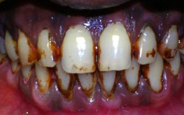 6. Bakarken bile tuhaf oluyorsunuz değil mi? Ama son sürat sigara içmeye devam ederseniz dişlerinizi ve diş eti sağlığınızın bozulma olasılığı ne yazık ki çok yüksek.