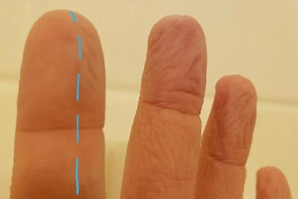 2. ''İşaret parmağımdaki bir siniri incittiğim için parmaklarımın yarısı düzelmiyor.''