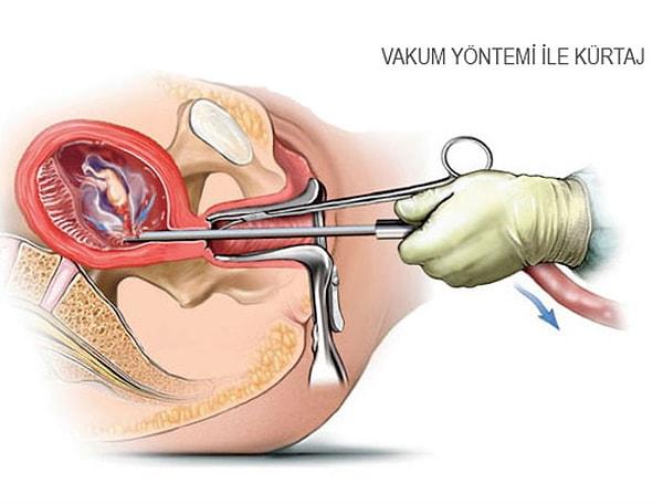 Her ne kadar yasa dışı olduğu düşünülse de, Türkiye'de 1983 yılından bu yana istenmeyen gebelikler 10. haftaya kadar isteğe bağlı olarak sonlandırılabiliyor.