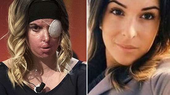 Ayrıldığı Sevgilisi Tarafından Asitli Saldırıya Uğrayan Güzellik Kraliçesi: Gessica Notaro