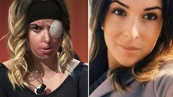 Ayrıldığı Sevgilisi Tarafından Asitli Saldırıya Uğrayan Güzellik Kraliçesi: Gessica Notaro