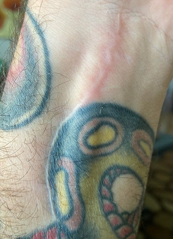 1. «Мой врач выбрал такой маршрут, чтобы не испортить татуировку во время операции».