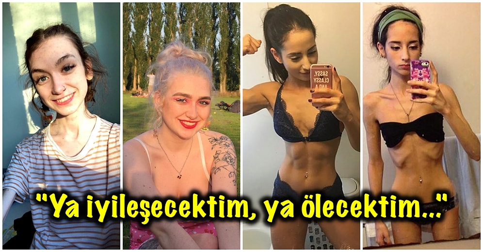 Anoreksiya Hastalığını Yenip Kilo Alarak Bambaşka Biri Gibi Gözüken 21 Kişi