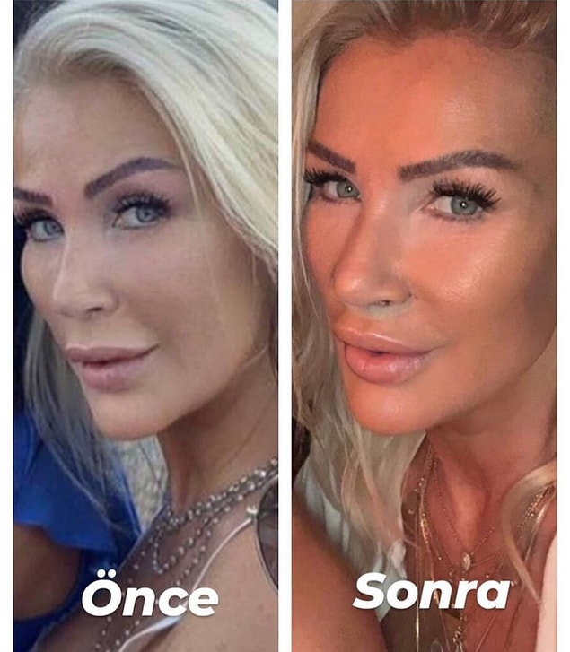 Öncelikle belirtelim ki, bizim ruhumuz bile duymasa da birçok ünlü 'lip lift' dediğimiz bu işlemi yaptırıyor.