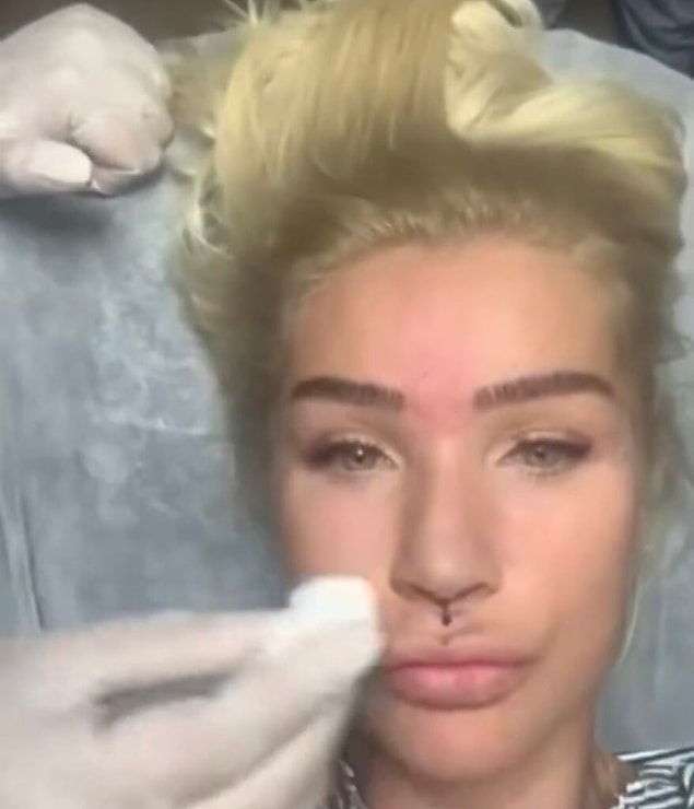 Bu isimlerden biri de Seda Sayan. Geçtiğimiz günlerde kendisi, lip lift işlemi sırasında sosyal medya hesabından bir paylaşım da yapmıştı hatta.