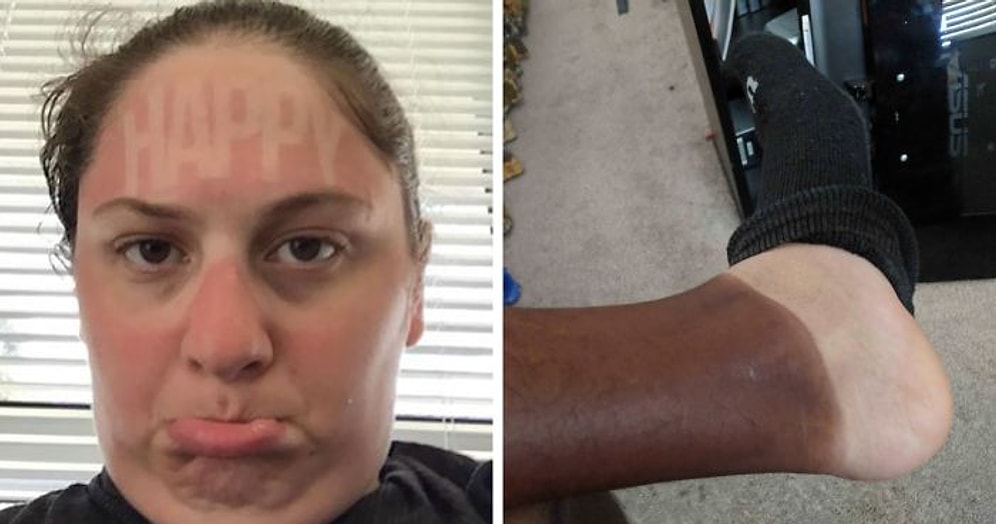 Самая горячая подборка неудачного загара этого лета, или 20 случаев, когда люди забыли нанести солнцезащитный крем (Часть 1)