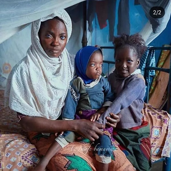 Ее старшая сестра Баликис объясняет: «Когда моя сестра родилась, люди думали, что у нее проблемы с глазами. Однако врачи сказали во время медицинского осмотра, что с ее глазами не было проблем, просто у нее были другие глаза».