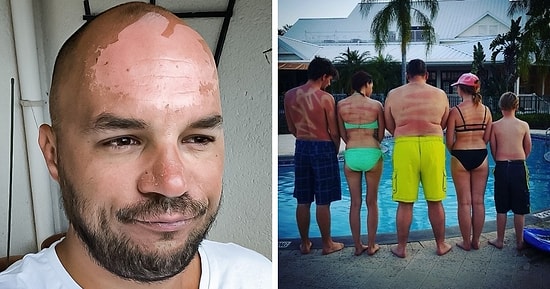 17 фотографий людей, которые недооценили солнце и очень зря