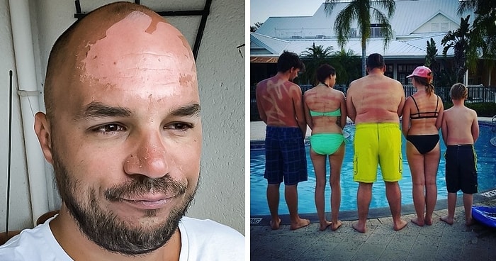 17 фотографий людей, которые недооценили солнце и очень зря