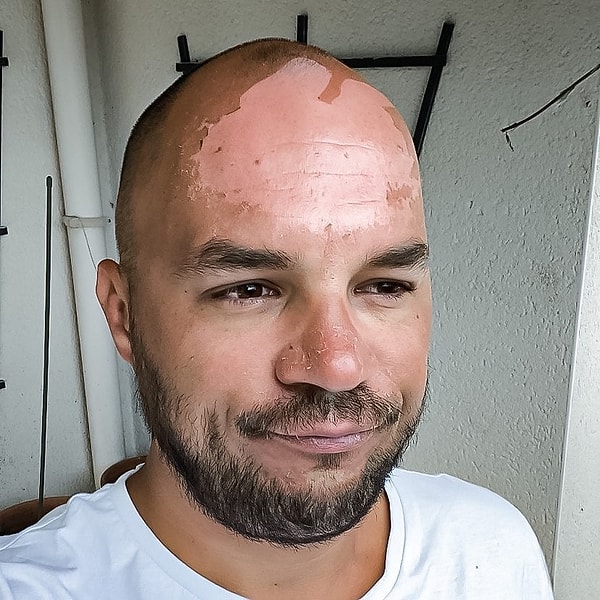 13. «3 дня на солнце, явно недостаточное количество средства от загара и большой лоб»