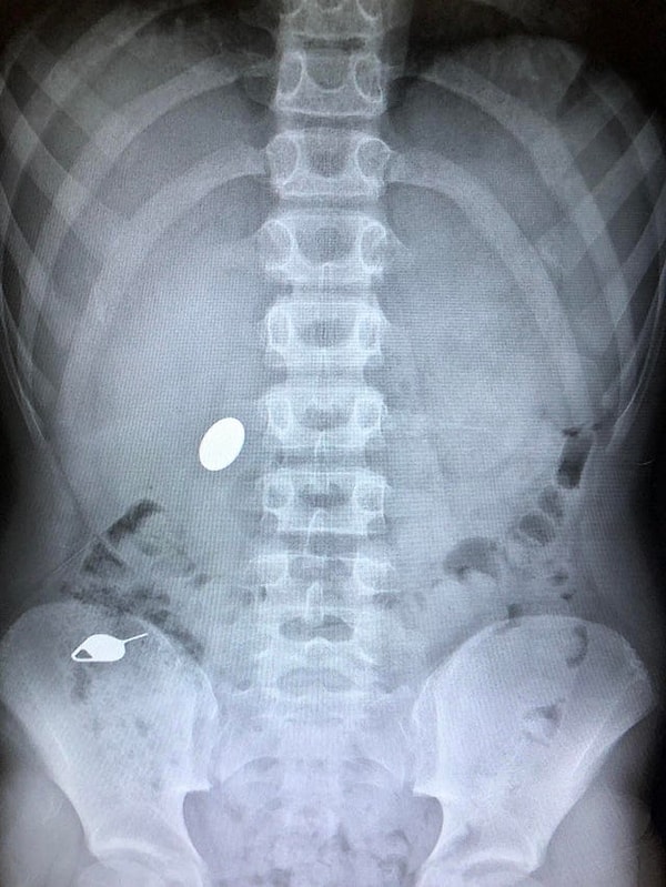 1. «Сын проглотил монетку, пока показывал брату, как он за день до этого проглотил ключ»