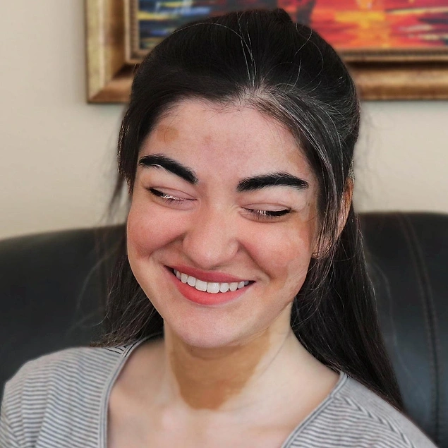 "Vitiligo hastalığım kirpiklerimin üst kısımını beyaz rengine çevirdi."