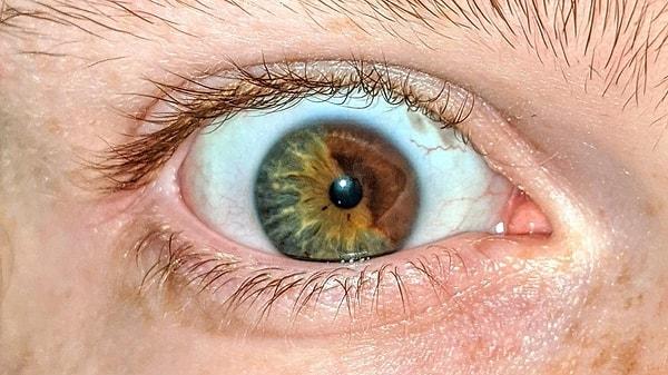 6. "Gözümdeki sektörel heterokrominin (irisin farklı bölümlerinde iki farklı renk) fotoğrafını çekmeyi başardım."