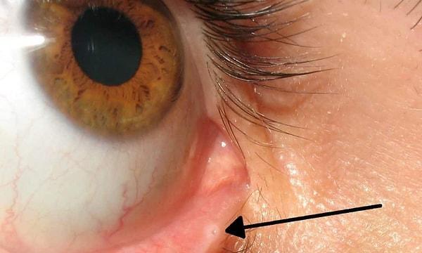 2. Alt göz kapaklarındaki delikler fazla göz yaşını burnunuza gönderir. Bu da ağlarken burnunuzun akmasına neden olur.