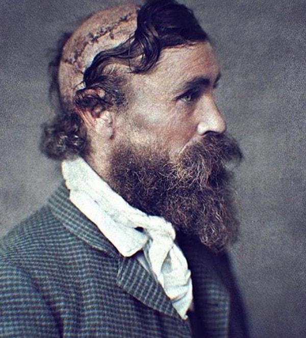 13. 1864 yılında beyninden yaralanan kişinin ameliyat sonrası hali.