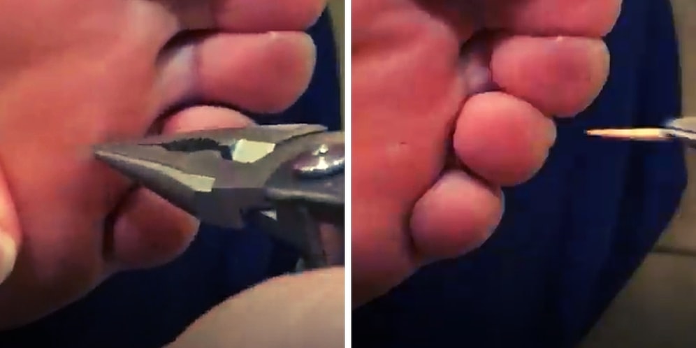 Ayağına Batan Şeyi Çıkaran Adamın Ayağından Çıkardığı Şey Sizi Şoke Edecek