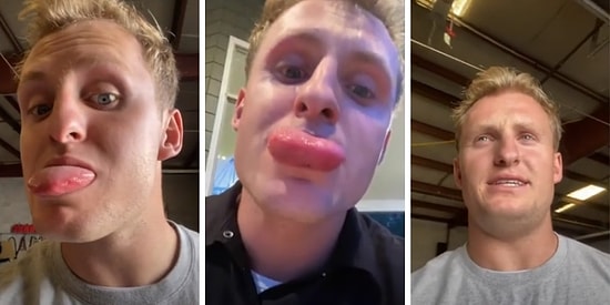 Pişmiş Tavuğun Başına Gelmeyen Onun Başına Geldi: Burger Yerken Dilini Arı Sokan Adamın Dramı