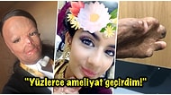 Kullandığı Bit Şampuanı Alev Alınca Yüzü ve Vücudunun Yarısından Fazlası Yanan 16 Yaşındaki Talihsiz Kız