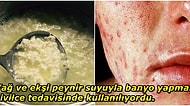 Sivilcelerden Kurtulmak İçin Ekşi Peynirle Banyo Yapıyorlardı! Antik Roma Dönemine Ait Birbirinden İğrenç Tedavi Yöntemleri