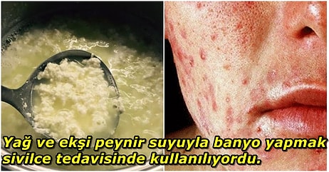 Sivilcelerden Kurtulmak İçin Ekşi Peynirle Banyo Yapıyorlardı! Antik Roma Dönemine Ait Birbirinden İğrenç Tedavi Yöntemleri