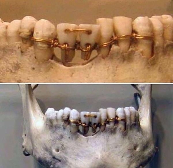 9. 4000 yıl öncesinden kalmış bir mumyanın eski teknoloji diş telleri.