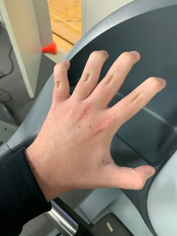 7. «Я могу только верхние фаланги пальцев, не сгибая другие суставы».