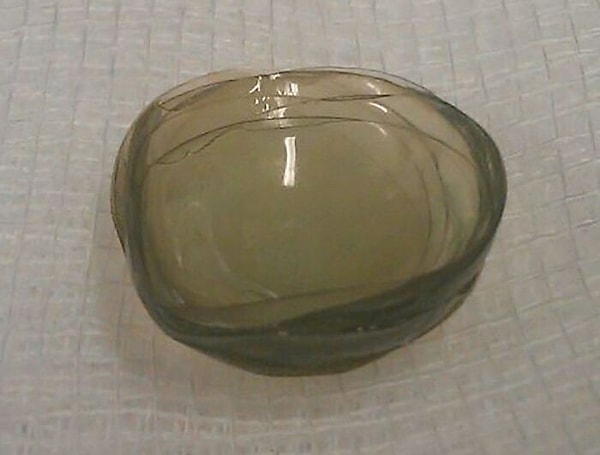 18. Врачи обнаружили 27 контактных линз в глазу женщины